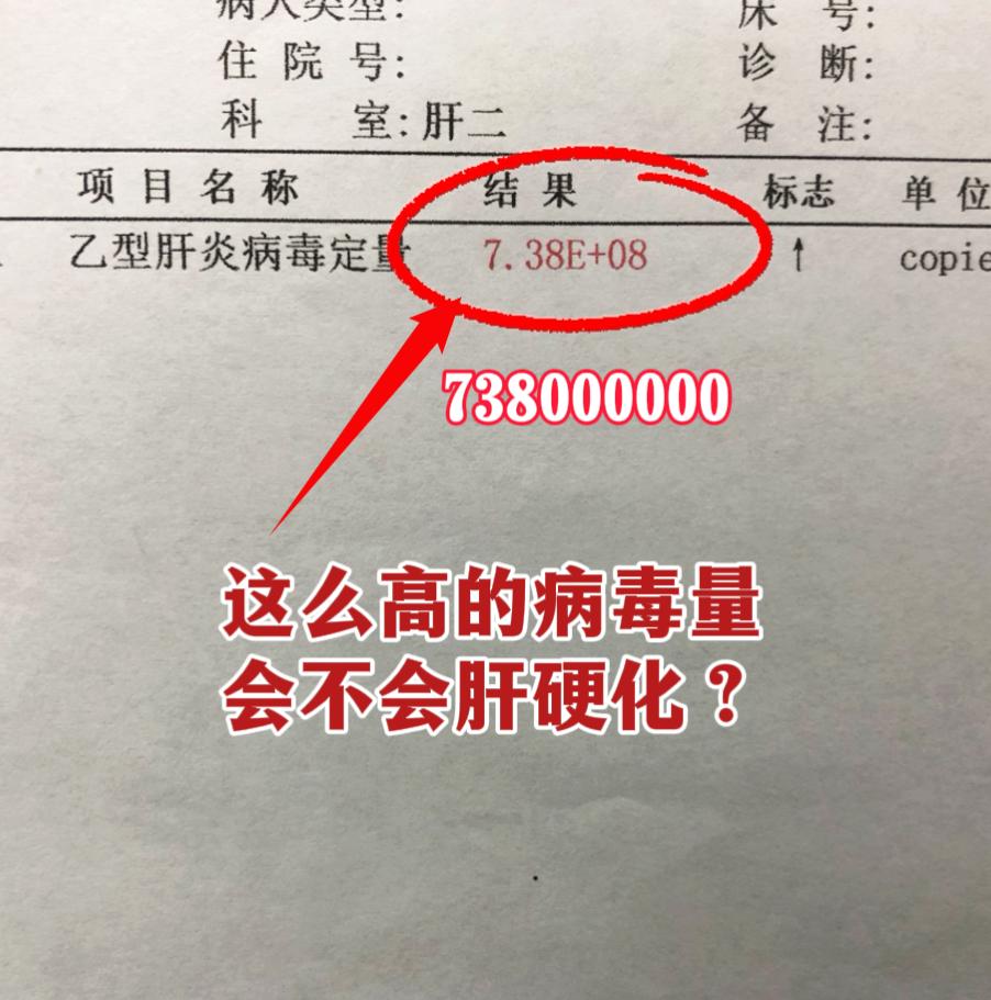 病毒量8次方，就一定会肝硬化？别自己吓自己！ 门诊上一位山东本地的患者...