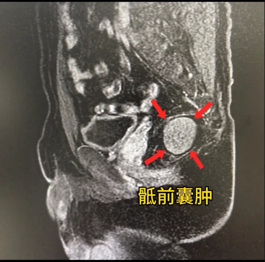 骶前囊肿切除加骶尾骨切除