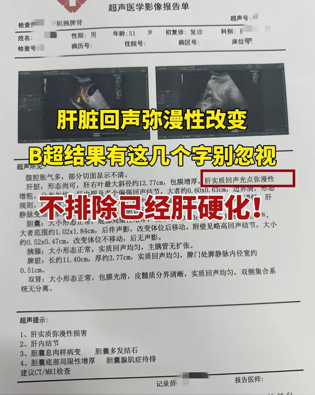 一位山东莱芜的粉丝问我，肝脏彩超上提示“弥漫性改变”严重吗？因为检查结...