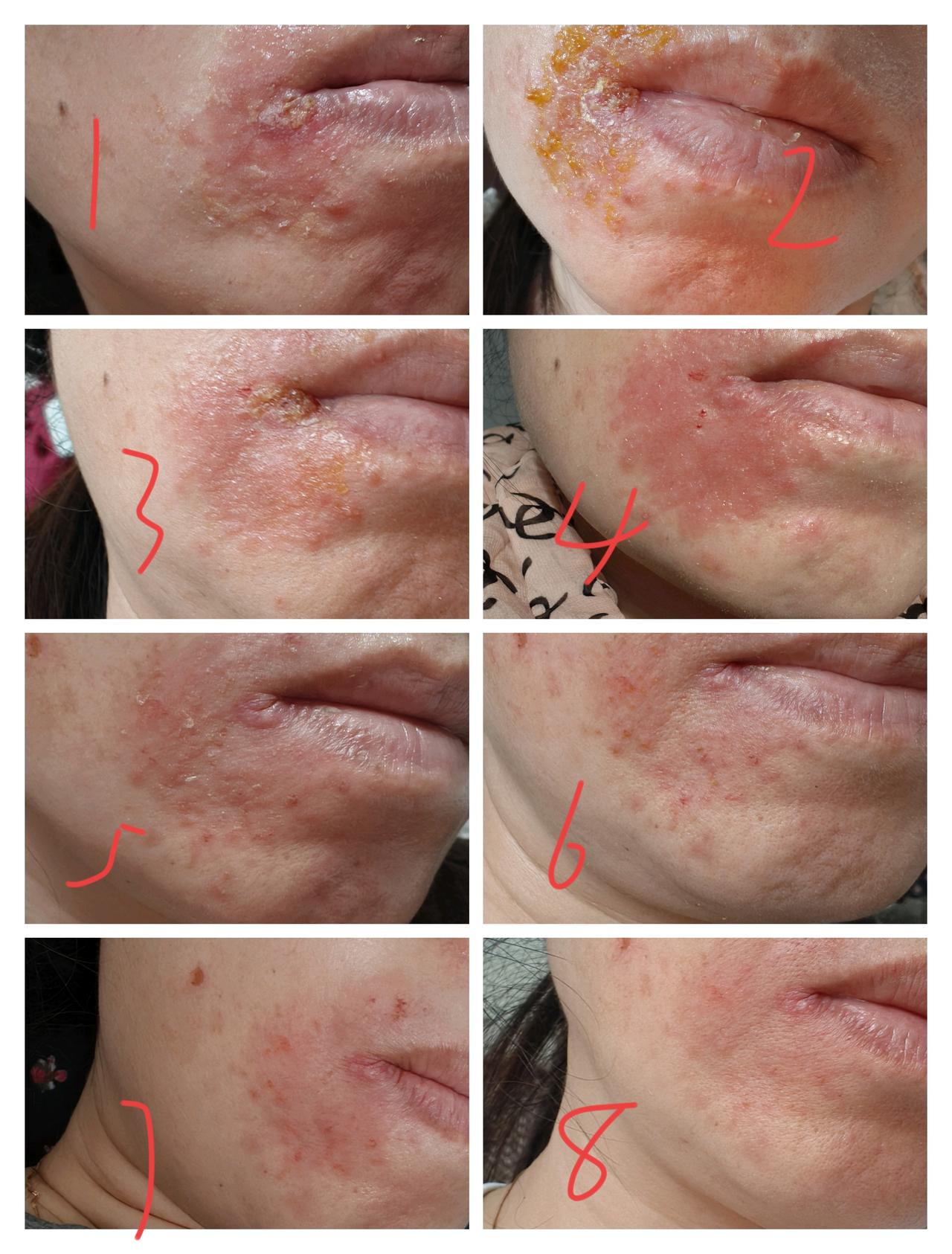 是不是过于关注一件事情，时间就会过得很慢很慢~
最近得了疱疹，烂脸，二十多天了，