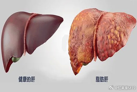 某人得了个脂肪肝，引发糖尿病。之前一直劝不要这样饮食，要怎样怎样，不然肯定会得病