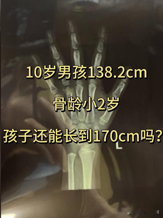 10岁男孩138.2cm，骨龄小2岁，孩子还能长到170cm吗？

之前接诊过一