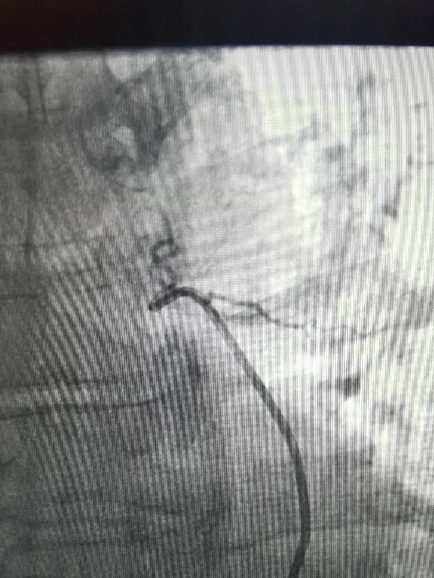 急诊咯血介入治疗，胸上动脉，锁骨下动脉分支，右侧支肋共干支气管动脉，右侧支气管动脉，食管固有动脉，左侧支气管动脉，右侧膈动脉，术前CTA以及选择合适的大导管和微导管真的重要，不仅能超选到位，又能快速完成超选。