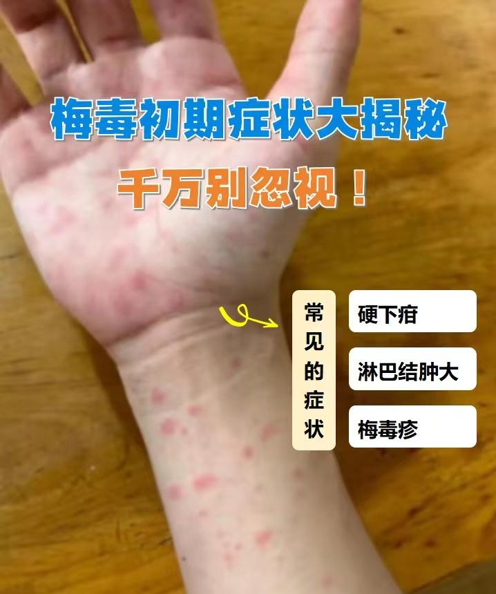 日本“梅毒”病例激增，年轻人不以为耻反以为荣，社会危机突显。


日本是一个文化