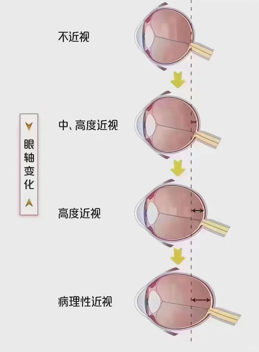 开学后近视防控细节