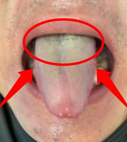 说的就是这种舌头！房事力不从心，湿热之症是元凶[绿帽子]

一位男病友32岁，今