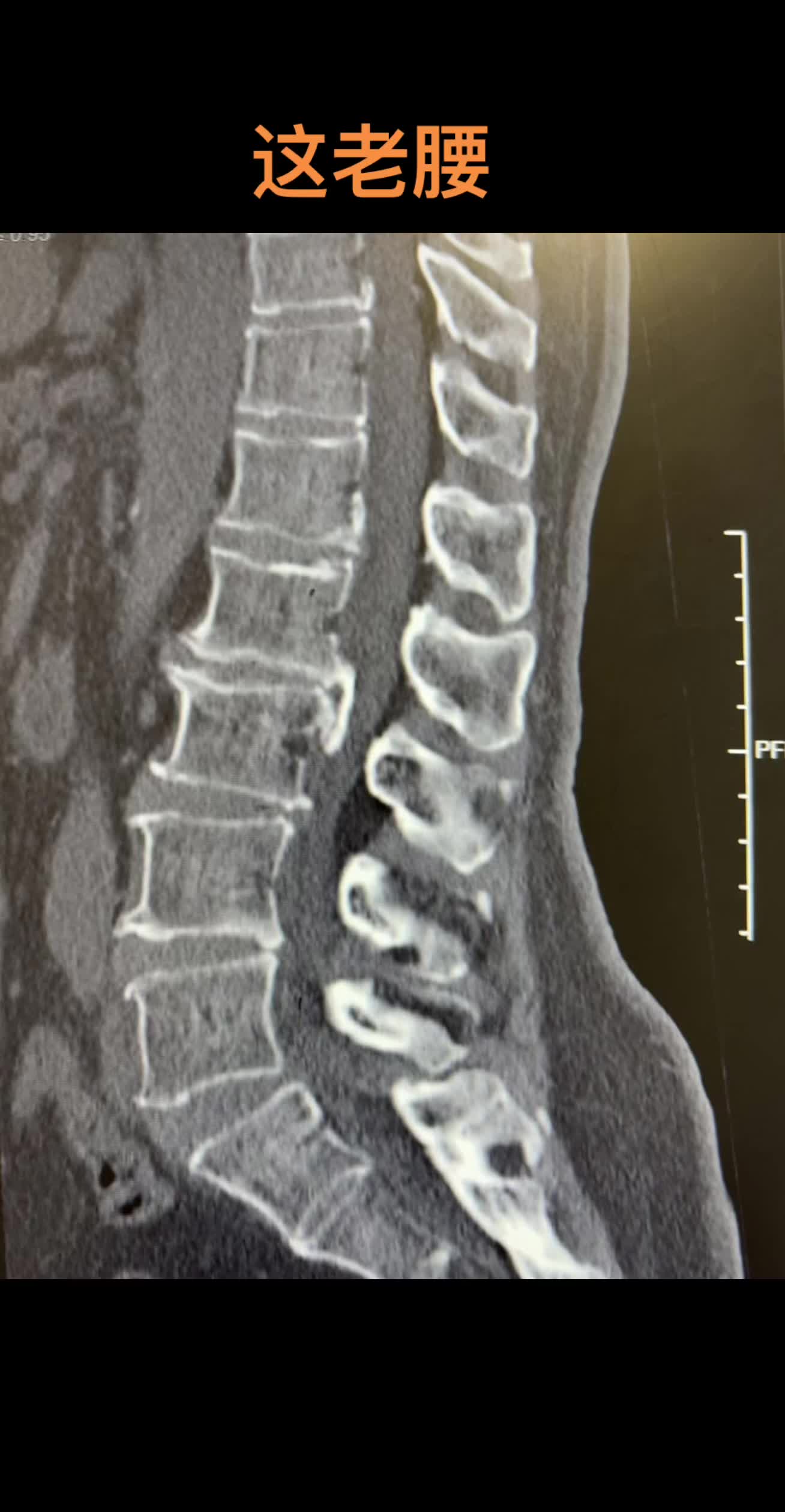 腰痛 骨质增生教科书般的退行性腰椎病