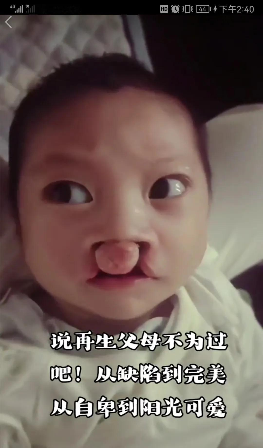 一位唇腭裂儿童的治疗，和恢复过程。曾经因唇腭裂黯然失色的童年，因李亚鹏的坚持与守