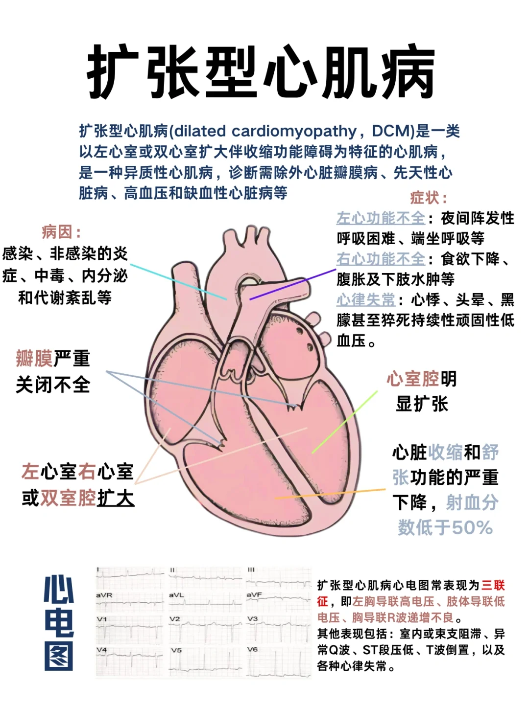 医学生笔记——扩张型心肌病