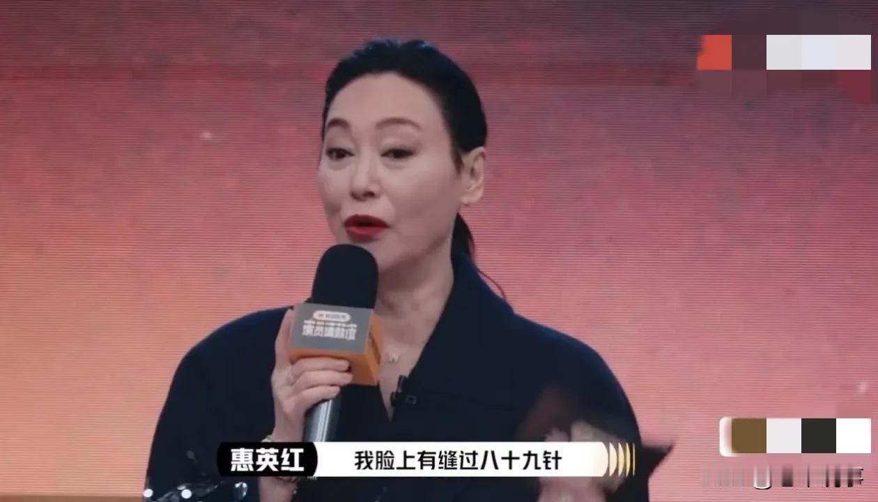 惠英红曝脸上缝89针，这才是真敬业！
 
在娱乐圈这个充满光环与诱惑的地方，很多