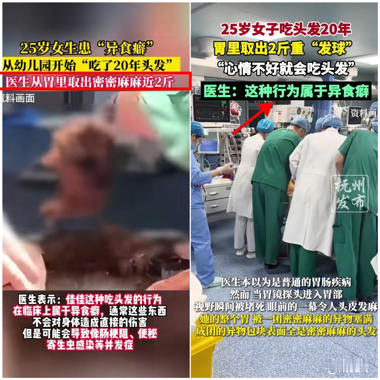 杭州女子胃痛到肚子硬如石头，胃镜检查竟查出胃里塞满头发，手术取出
两斤重毛发团，