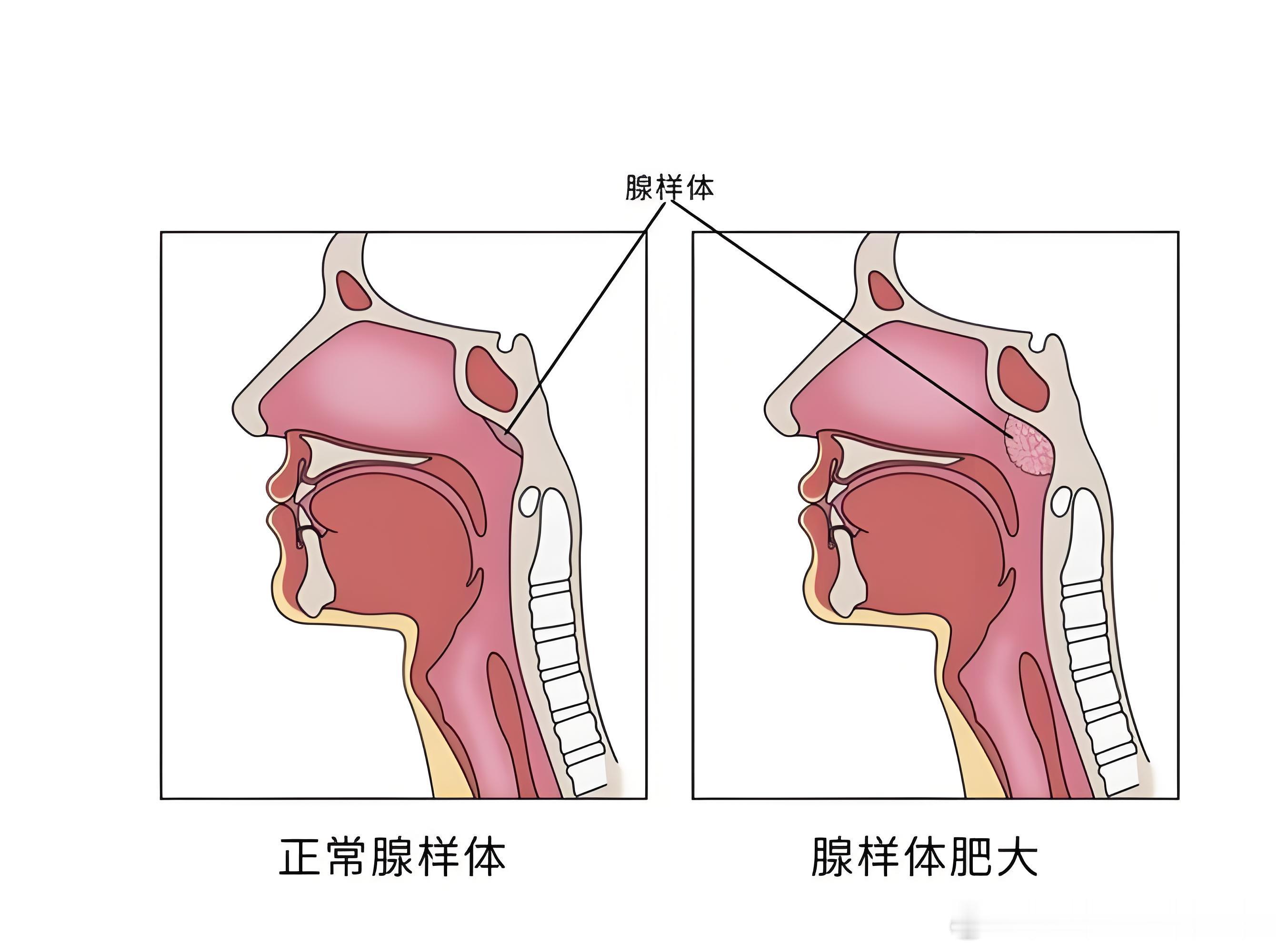 劝各位家长别再忽视孩子睡觉打呼噜这件事，今天门诊连续接诊好几个已经出现腺样体面容