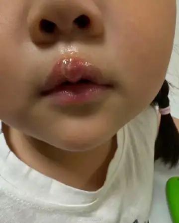 用热熔枪烫女孩嘴唇老师辩称失误你们来看看把孩子的嘴烫成啥样了！有孩子的看不得这种
