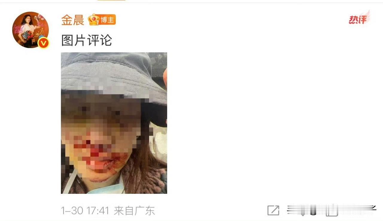 警方通报“金晨事件”，艺人发文道歉，并晒出受伤照片！
1月30日，对于网友比较关