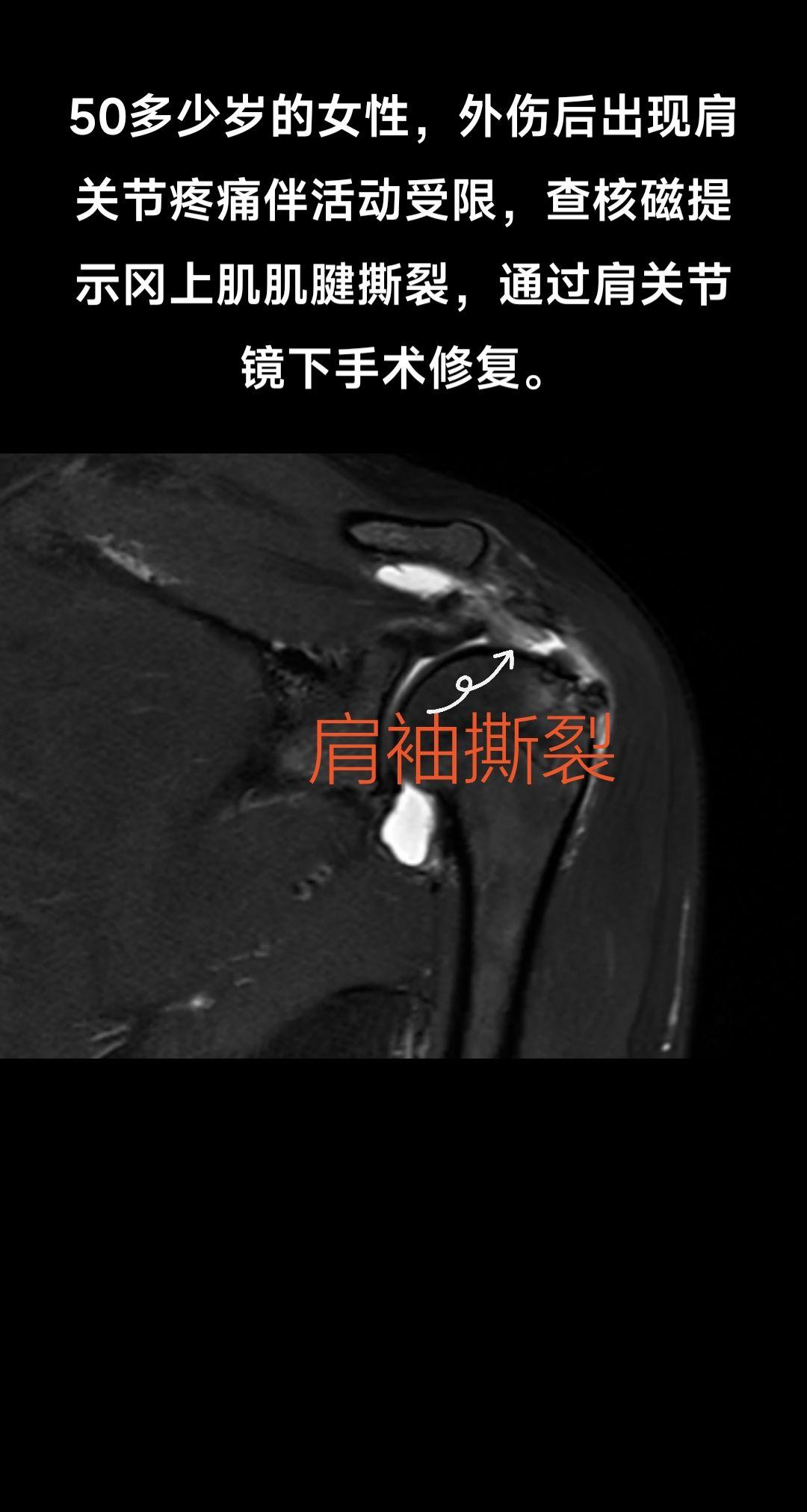 关节镜下肩袖撕裂修复。