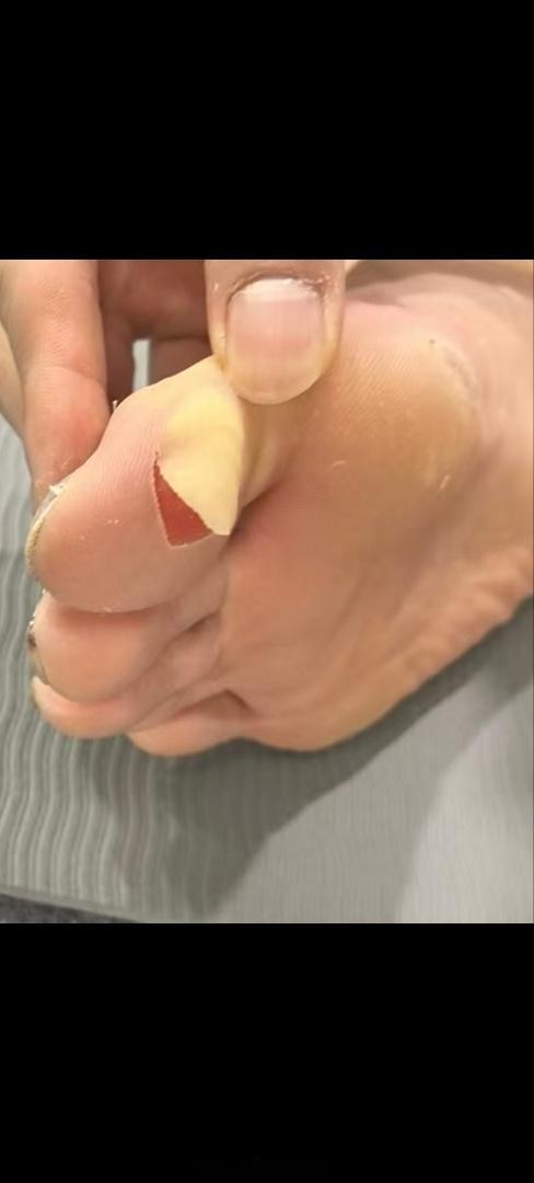 石宇奇脚趾起水泡 孙俊：大家理解热点现场