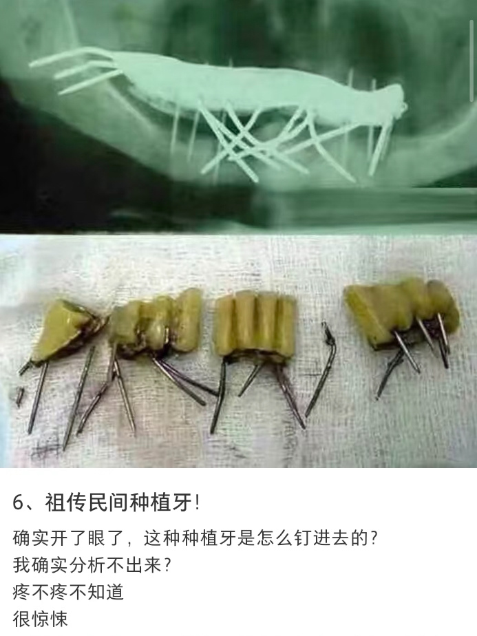 好惊悚… 想起之前网购补牙材料导致凝固一嘴的老人…