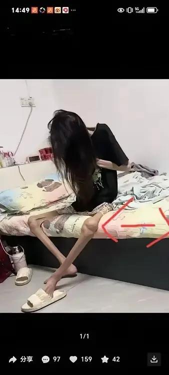 什么病？导致妙龄女子肌肉流失，骨瘦如柴？瘦骨头女孩 肌肉疾病 太瘦了抵抗力差