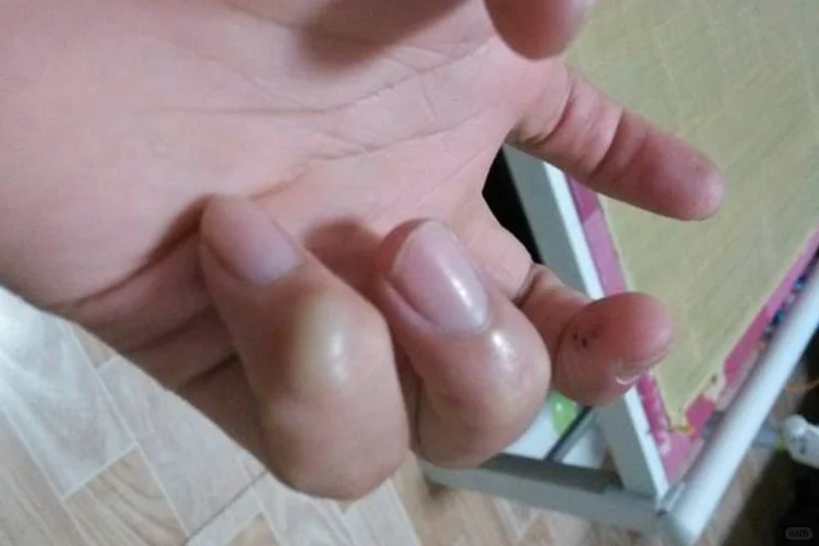 小拇指腱鞘囊肿图片