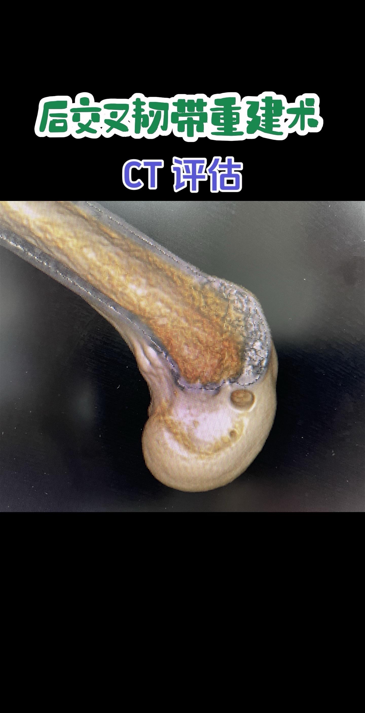 后交叉韧带重建术后影像评估。每一条韧带，都是膝盖的隐形安全带。而精准重...