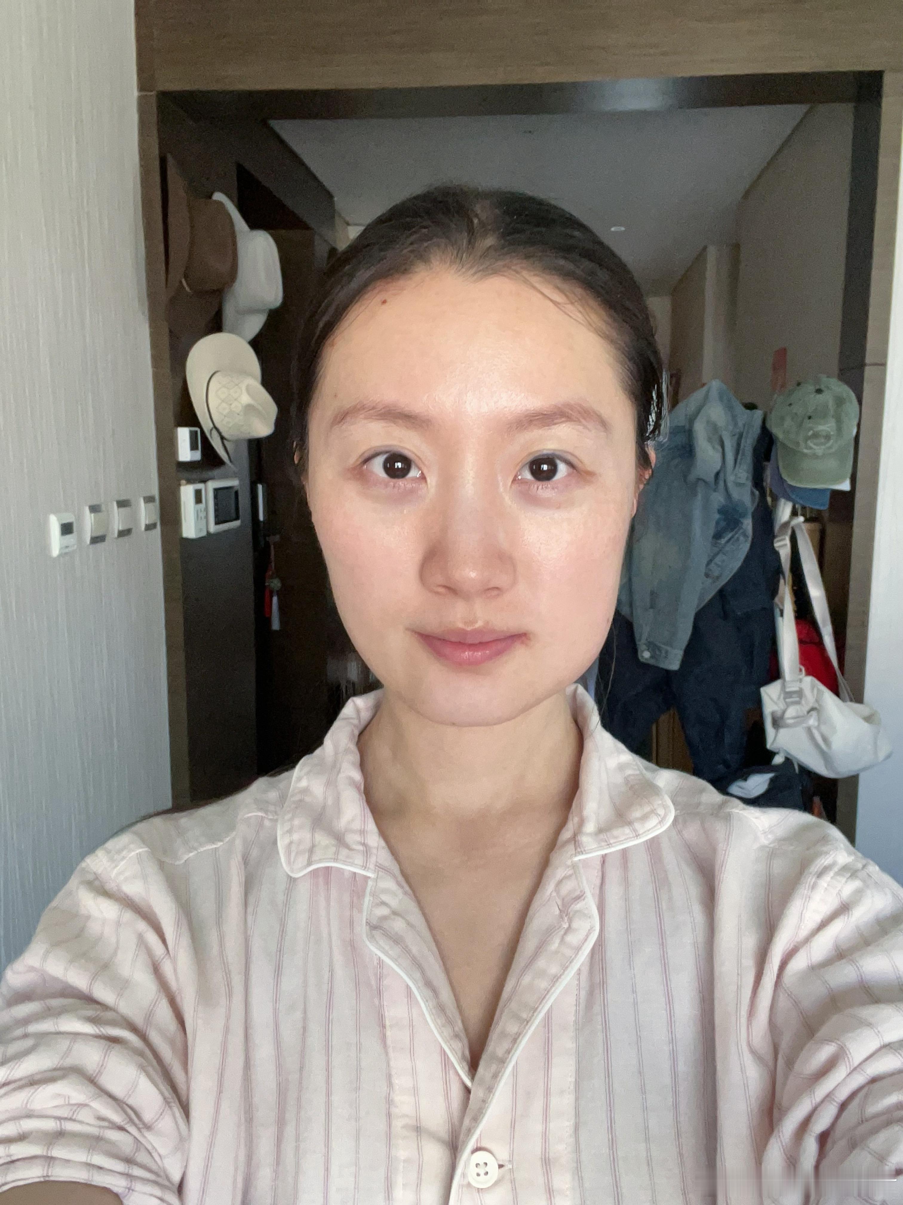 昨天拔完牙只是微肿今天怎么像被人揍了