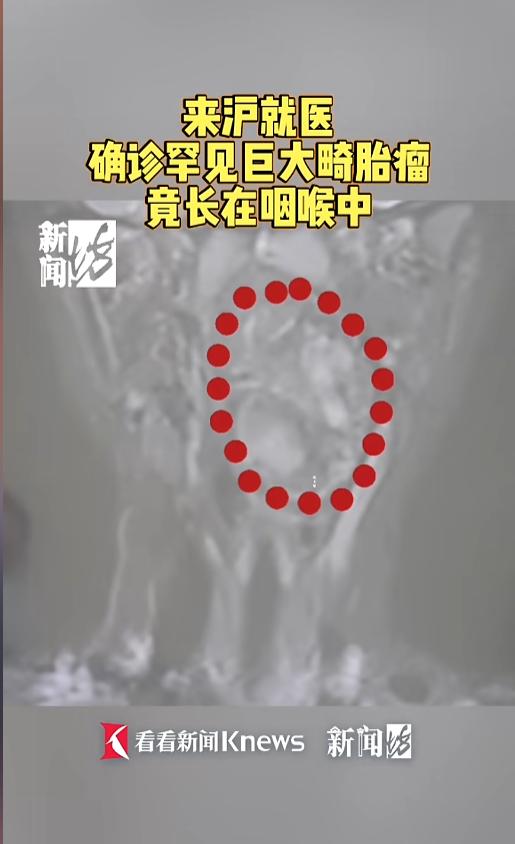 “太吓人了！”安徽一位妈妈带着6岁儿子冲进急诊室，满脸都是泪水与绝望。这孩子打呼