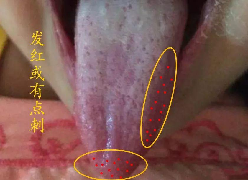 肝火旺的人，不只是舌头发尖，特点是舌尖和舌两边会发红，或出现点刺。
舌尖属心，反