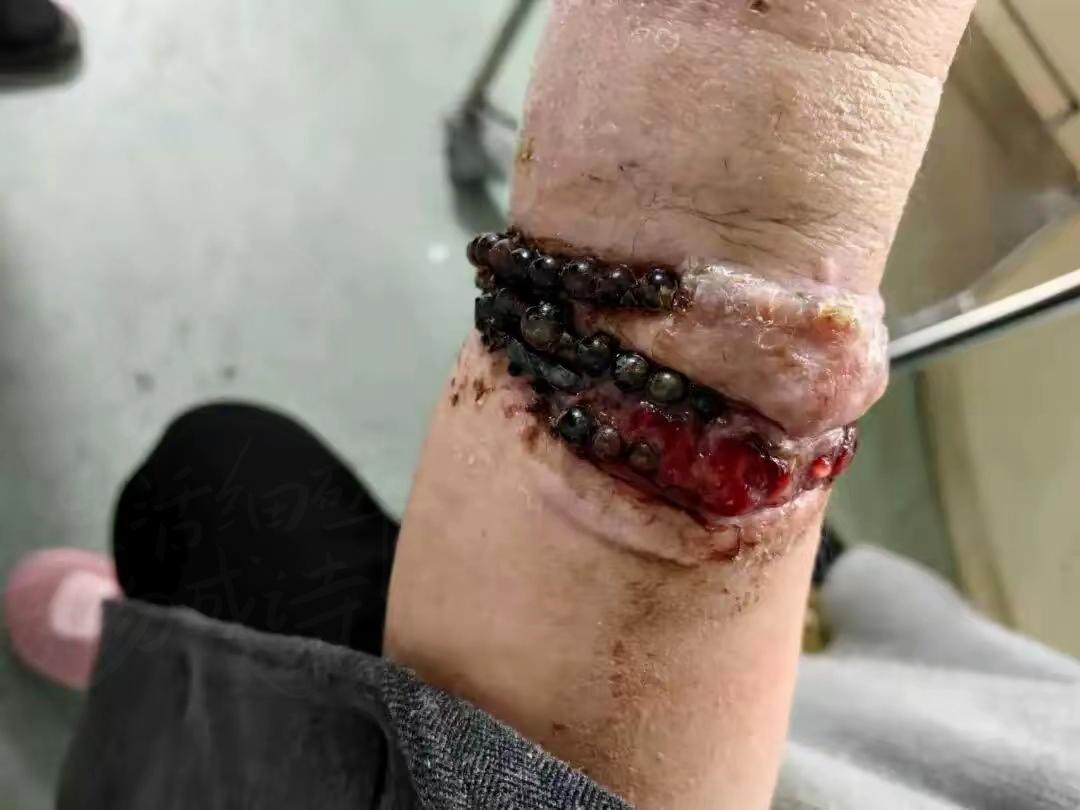 吓出冷汗！戴了十年的手镯竟和肉长在一起，福建这位女士的经历真给所有人敲了警钟！