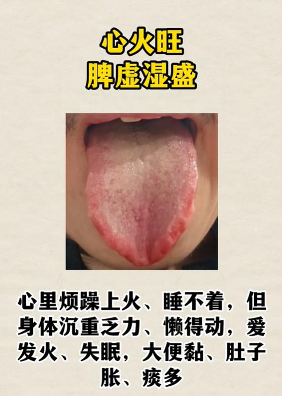 胖舌辨体质，分清火旺夹湿与脾肾两虚表现