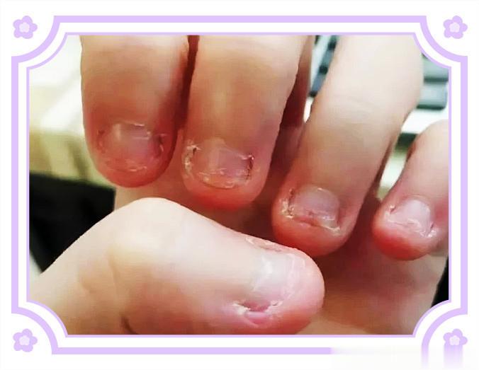 #国医的精诚力量# 孩子痴迷于咬指甲的食物疗法——乌梅山楂汤。中医认为孩子痴迷于