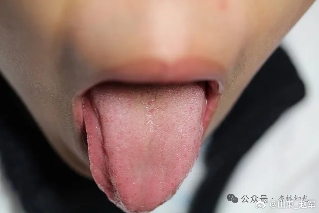 李玉宾老师讲舌诊木气下面我们来看木气的舌头，我们平时遇到的问题大多都是中土、升降