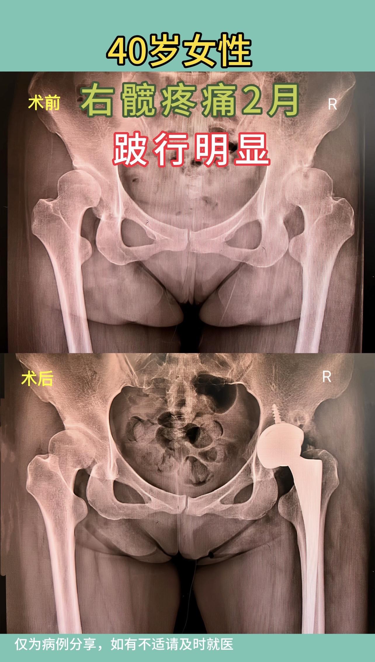 40岁女性，右髋疼痛2月，跛行明显。先天性髋关节发育不良，手术难度大。...