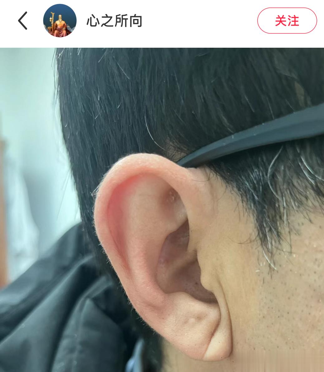 啊，又学到新知识，耳朵上出现这个沟，有可能是心律不齐沟。我赶紧把家人耳朵看了个遍