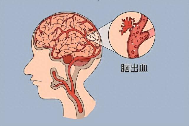 脑溢血去世的越来越多，建议:1不喝、2不碰、3坚持，别大意