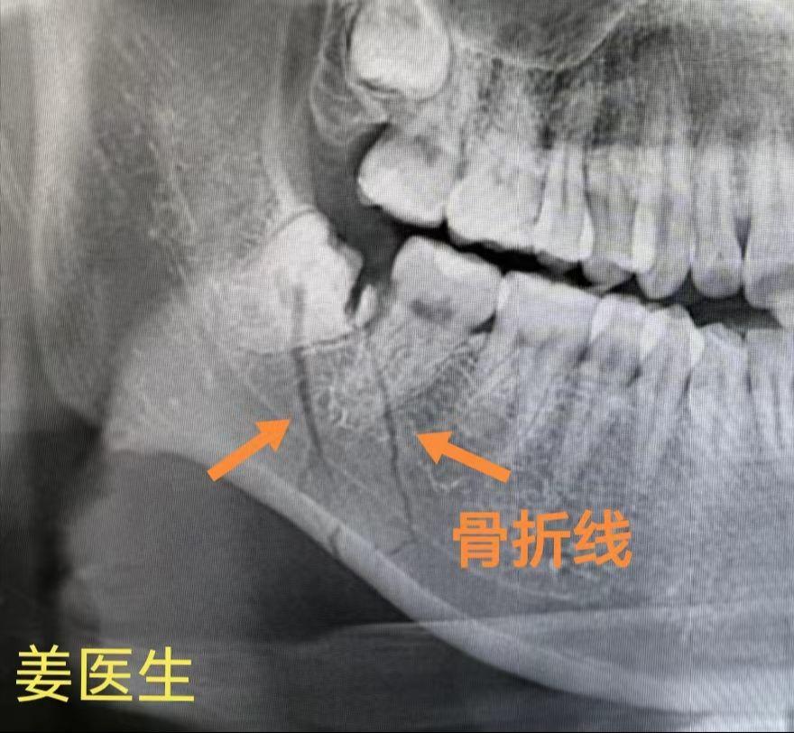 下颌骨骨折。阻生牙拔除是“力与技巧”的结合，单纯暴力有很大的安全隐患！...