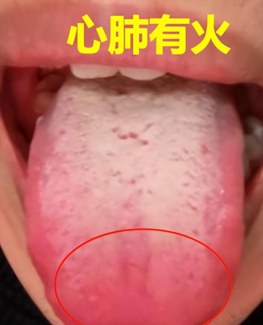 为啥你一动就满头大汗？三焦火太旺了！送你3方对症调，出汗问题连根拔！

①脖子汗