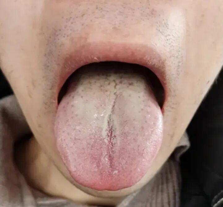 这种舌象，看似男科问题出在肝肾，实际上根源在于脾!
患者症状：勃起不坚，性生活时