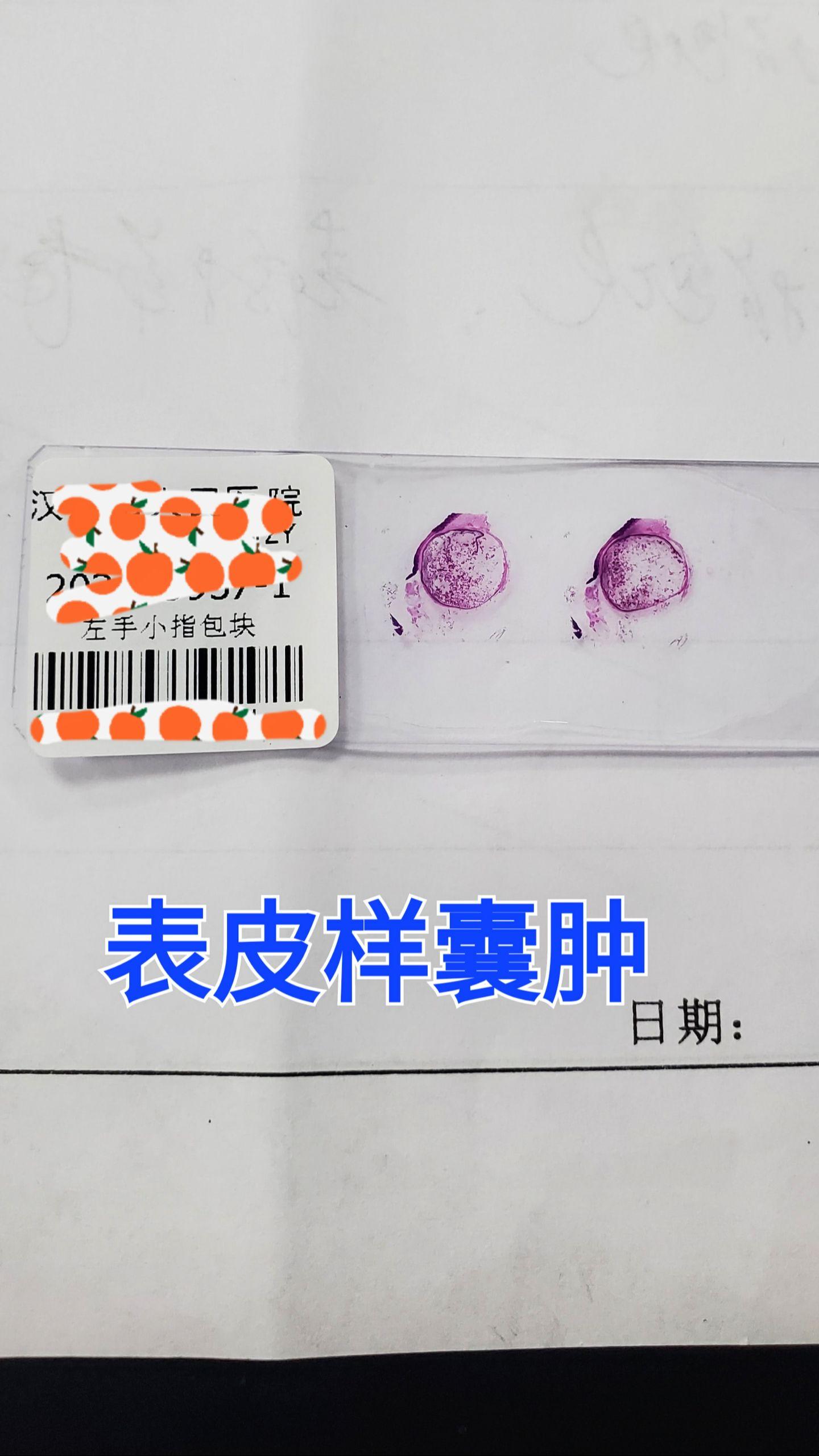 表皮样囊肿