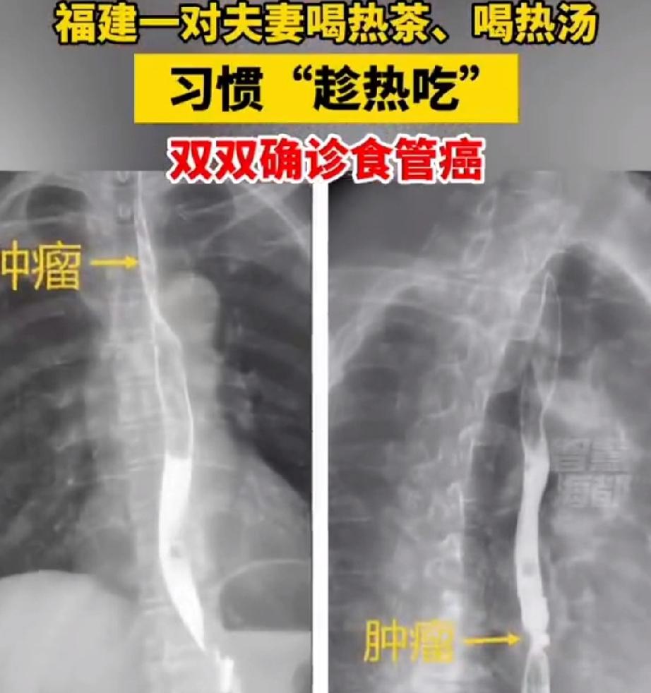 趁热吃，不一定是个好习惯。如果太烫了，就会惹来疾病。
福建泉州的徐先生，今年56