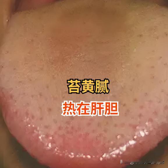 苔黄腻热在肝胆，苔黄燥热在脾胃
 
很多人，一看到舌头发黄就觉得是湿热，盲目的去