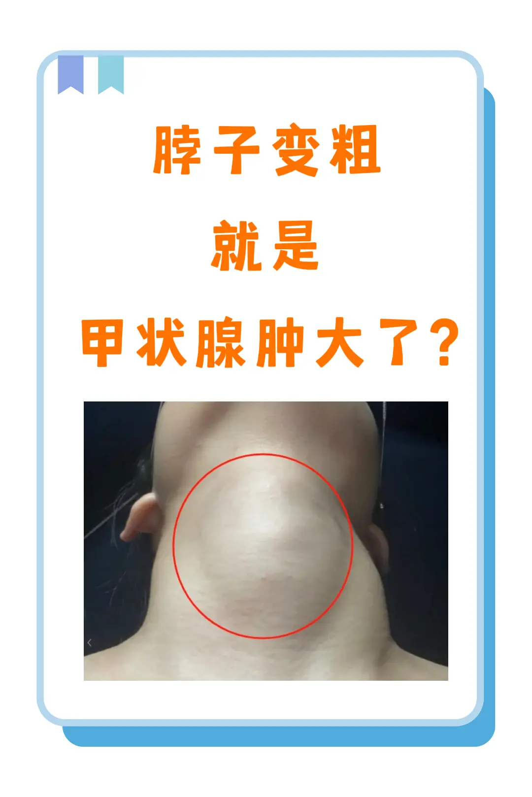 脖子粗可能是甲状腺疾病的信号。脖子的增粗，可能是一种无声的警示，提示我...