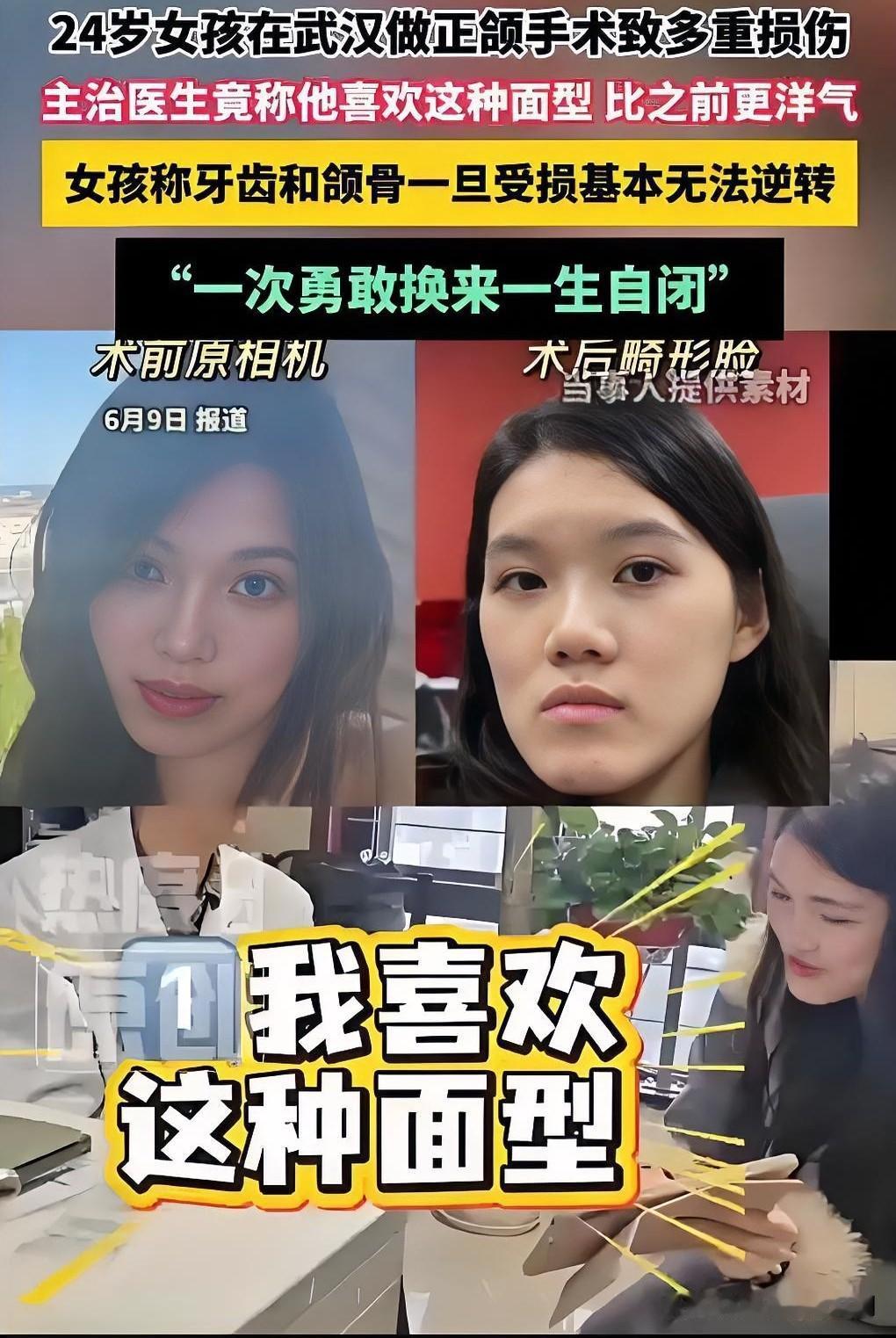 原本只是去医院咨询常规正畸的小雨，却被过度推荐开展了不必要的正颌手术，术后面部严