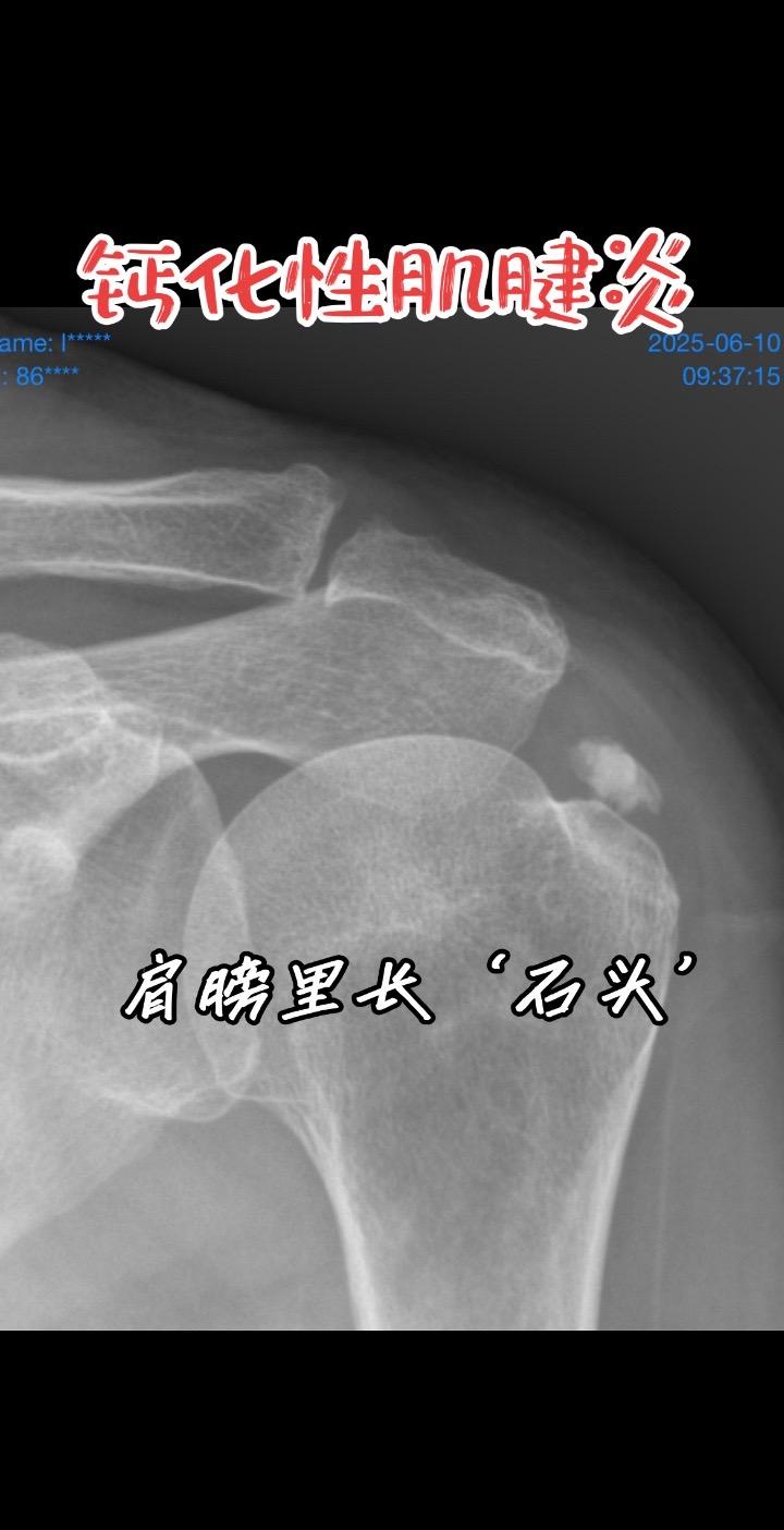 钙化性肌腱炎。半夜痛醒、抬手都困难，片子里亮亮的那一团就是罪魁祸首！