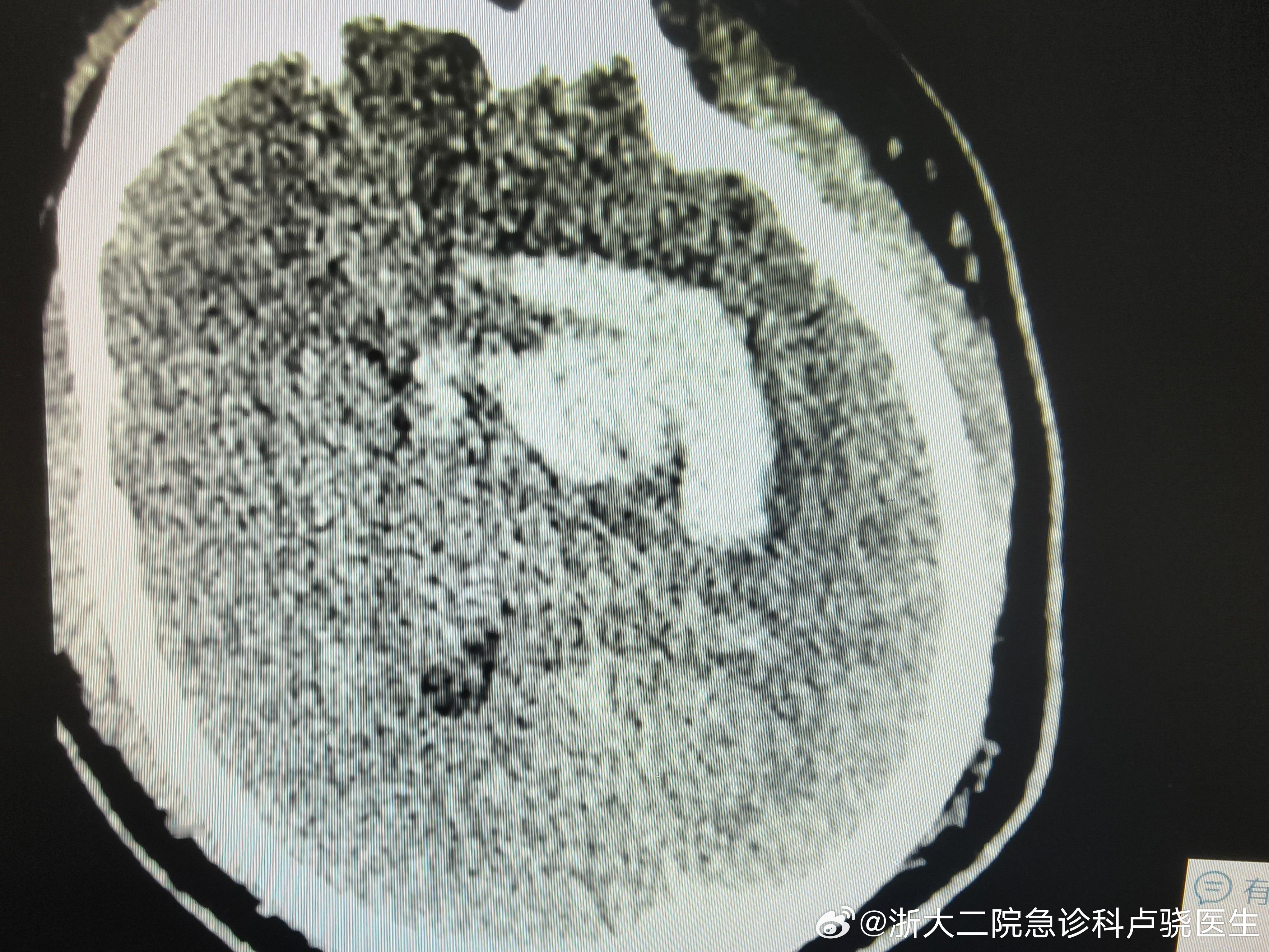 连续两个30多岁的脑出血，昏迷。冬天到了，年轻人也要注意保暖，高血压及时处理，反