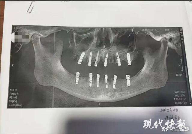 【男子一次性拔牙23颗种12颗，13天后去世】近日，浙江永康市居民舒女士报料称，