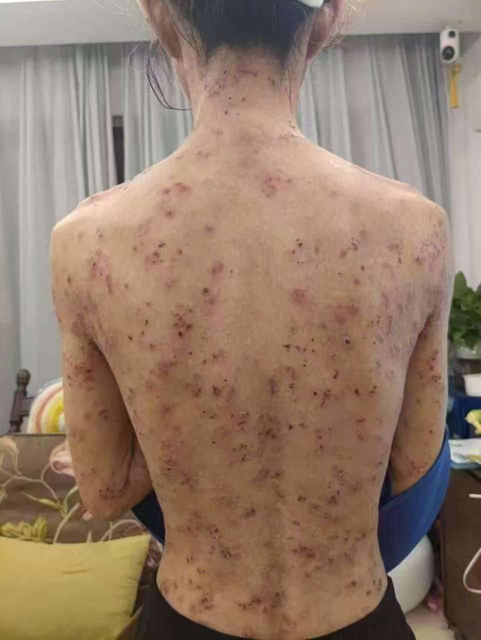 女朋友说蚊子叮的，好心疼[可怜][可怜] ​​​