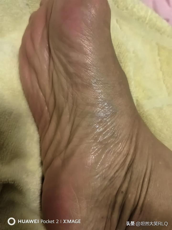 刮脚筋真的治睡眠，我一直靠喝酸枣仁水睡觉，自从看头条有人刮脚筋治疗睡眠，我便停了