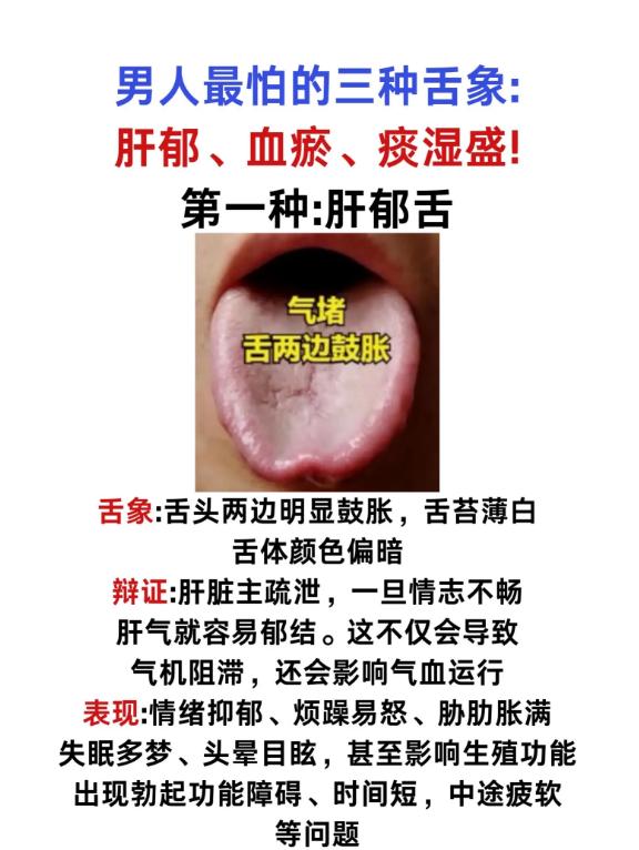 男人需警惕的三种舌象：肝郁、血瘀、痰湿盛