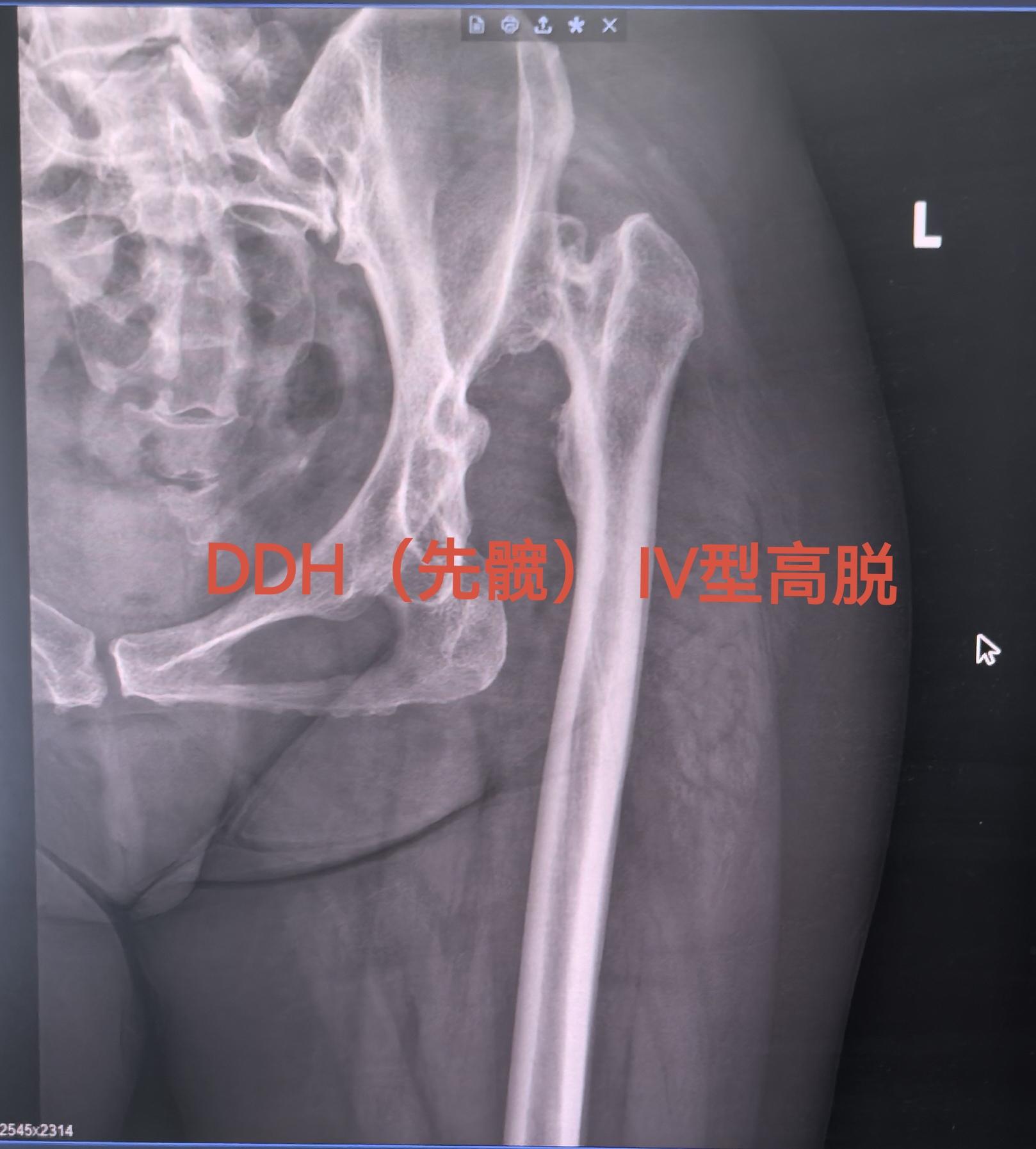 DDH先髋，高难度。DDH  Crowe IV型，高难度手术，半个骨盆...