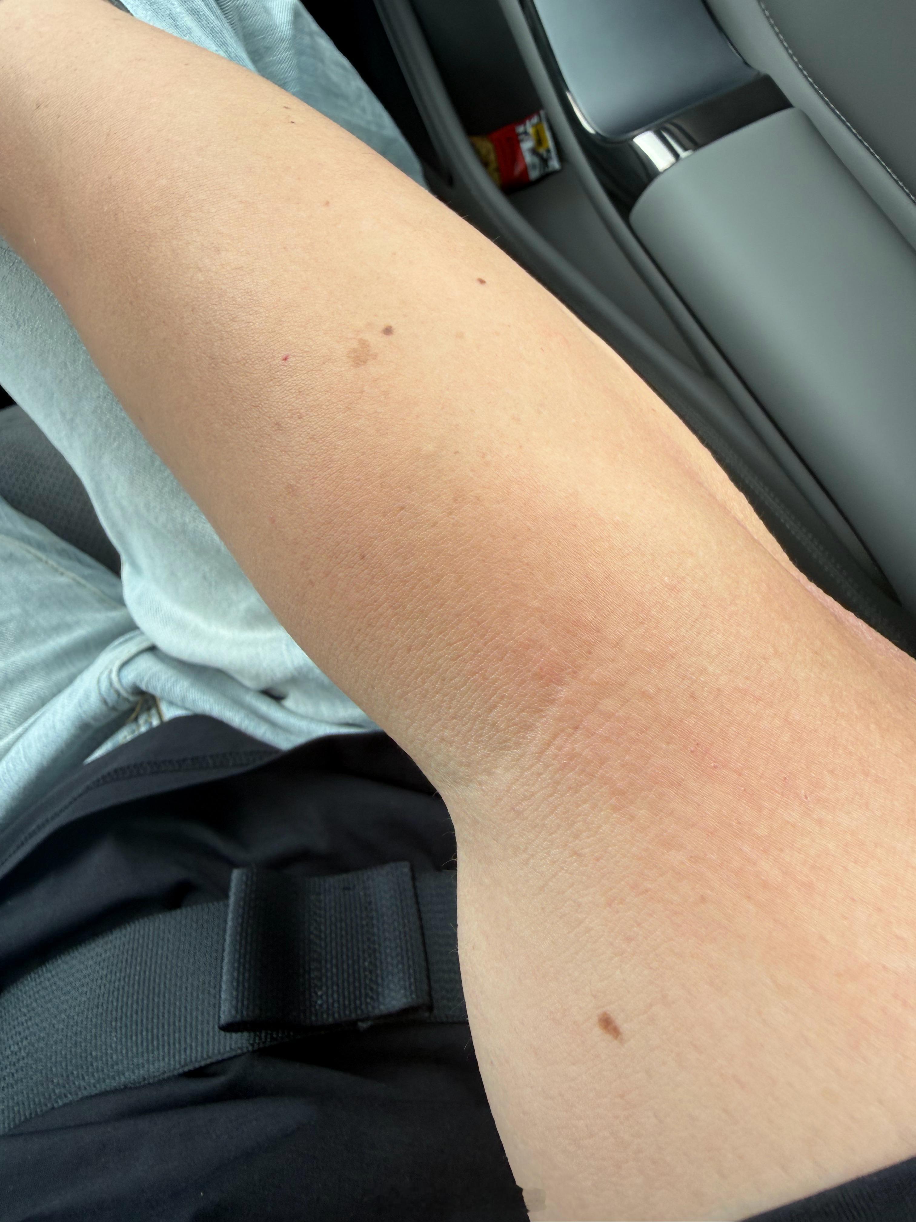 其实人是一根香蕉我看了下，确实身上会出现一些陌生的痣